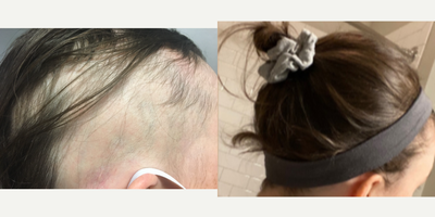 18-24 year old woman treated with Low-Level Laser Therapy - PRP + Low Level Laser Therapy + Proper Hair Care Regimen