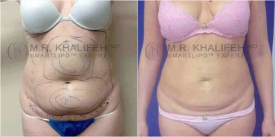 Woman treated with Liposuction - Woman treated with Liposuction