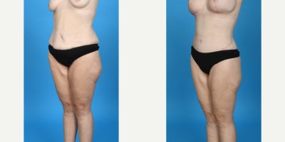 35-44 year old woman treated with Abdominal Etching, Body Lift, Diastasis Recti Repair, Drainless Tummy Tuck, Liposculpture, Lip - before and after breast lift with breast augmentation. This patient had significant weight loss and wanted a breast lift to lift and shape her breasts and a breast augmentation to add volume. I did a breast lift repositioning her nipple/areolar complex to the correct position on the chest and shaping her breast. For the augmentation is used a silicone gel gummy bear SoftTouch 345cc moderate profile.