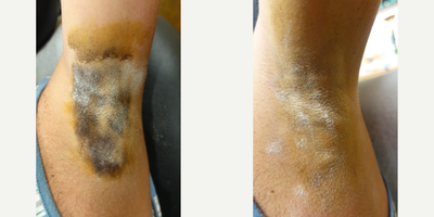 35-44 year old man treated with miraDry - Patient iodine starch test shown before and 2 weeks after miraDry treatment.An iodine solution is applied to the skin and allowed to air-dry. Then dry the area is dusted with cornstarch. When sweat reaches the surface of the skin the starch and iodine combine causing a dramatic color change (yellow -&gt; dark blue) allowing sweat production to be actively visualized.
