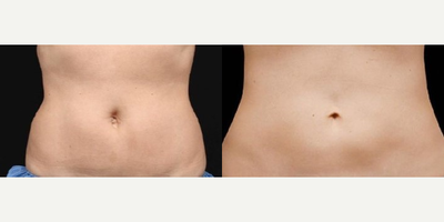 Woman treated with CoolSculpting Elite - These results are after ONLY 2 sessions of CoolSculpting Elite!