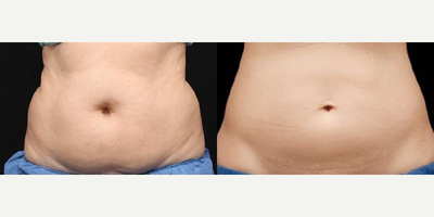 Woman treated with CoolSculpting Elite - These results are after ONLY 2 sessions of CoolSculpting Elite!