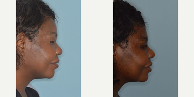 35-44 year old woman treated with African American Rhinoplasty - Challenging case of a female patient with very thick nasal skin who desired refinements to the nose. Her rhinoplasty techniques included an open approach, nasal skin de-fatting, radix graft, bilateral osteotomies, caudal septal extension graft for tip support, tip onlay grafts, and alar base reductions.