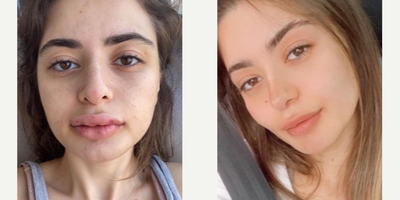 25-34 year old woman treated with Cheek Augmentation - 25-34 year old woman treated with Cheek Augmentation through facial fat transfer as well as Buccal Fat Removal, shown 3 months post op. Pre-op, patient was sad because of the shape of her face and wanted to have prominent cheeks.