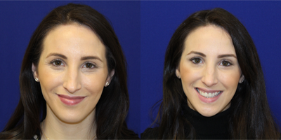 25-34 year old woman treated with Xeomin - 29 year old female feeling like she always looks tired. She wanted to do something quick that would make her appear rested and not look so worried or angry. She underwent xeomin injections to her forehead, glabella (11 lines) and crows feet. Here she is after a few weeks looking refreshed.