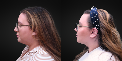 25-34 year old woman treated with FaceTite, Morpheus8 - Patient is pictured before and after FaceTite and Morpheus8 procedure to the neck and jowls.