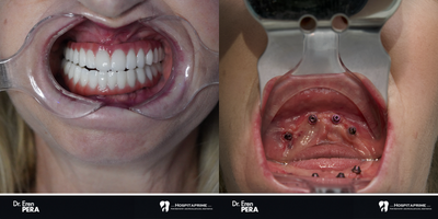 45-54 year old woman treated with All-on-4 Dental Implants, Dental Implants - zygomatic implants