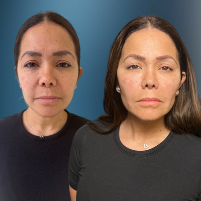 35-44 year old woman treated with Nonsurgical Facelift - The procedure focused on elevating sagging skin, particularly around the lower face and jawline, resulting in a more defined, elegant profile. Notice the softened lines, enhanced facial structure, and the refreshed, vibrant look that radiates from her skin, all achieved without the invasiveness of traditional surgery