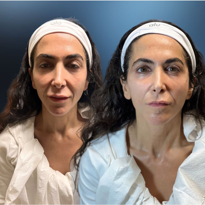 35-44 year old woman treated with Nonsurgical Facelift - The procedure focused on elevating sagging skin, particularly around the lower face and jawline, resulting in a more defined, elegant profile. Notice the softened lines, enhanced facial structure, and the refreshed, vibrant look that radiates from her skin, all achieved without the invasiveness of traditional surgery