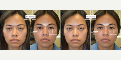 18-24 year old woman treated with Canthoplasty, Eyelid Retraction Repair, Eyelid Surgery, Facial Reconstructive Surgery - Young woman, with genetic Sanpaku eyes with bulging eyes and maxillary hypoplasia (flat midface) and lower eyelid retraction, underwent cosmetic orbital decompression (to treat bulgy eyes), infraorbital rim implant (to treat flat midface) and lower eyelid retraction surgery (to elevated lower eyelids and eliminate sclera show).