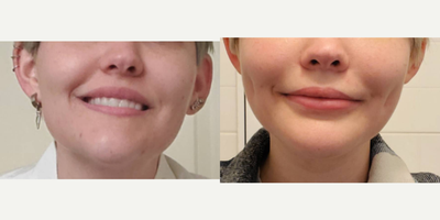 25-34 year old woman treated with Dimple Surgery - Dimple Surgery