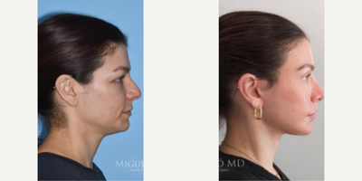 Woman treated with Lip Lift - Woman treated with Rhinoplasty, Facelift, Eyelid Surgery, Facial Fat Transfer, and Lip Lift.