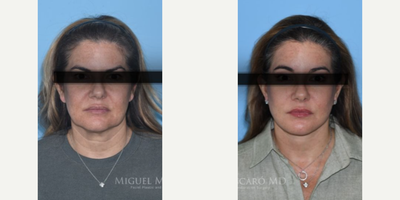 Woman treated with Brow Lift - Woman treated with Facelift, Neck Lift, and Brow Lift