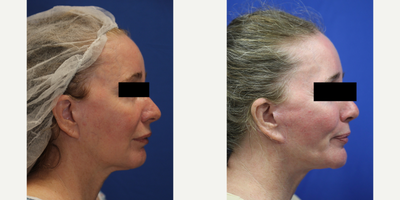55-64 year old woman treated with Silicone Injection Removal - Meet our resilient patient, a 55-year-old white female standing at 5'1 and weighing 117 pounds. She had silicone injected into her face and unfortunately experienced numerous health issues as a result. Concerned for her wellbeing, she turned to the renowned Dr. J. Timothy Katzen in Beverly Hills, CA, for help.Dr. Katzen skillfully removed the silicone from her face, providing her with much-needed relief. Our patient now feels much better and is grateful for the compassionate care she received. Her journey is a reminder of the importance of seeking out qualified professionals when considering cosmetic procedures and the potential dangers of unregulated treatments.