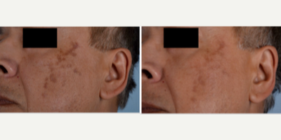 55-64 year old man treated with Chemical Peel - PCA Chemical Peel with Obagi Clear