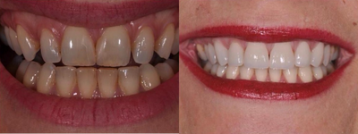 Permanent Teeth-in-1-Day Dental Implants - Permanent Teeth-in-1-Day Dental Implants