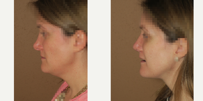 45-54 year old woman treated with Revision Rhinoplasty - revision rhinoplasty