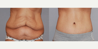 Lower Body Lift - Lower Body Lift
