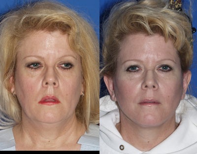 Quick Lift, Female - 
	Quick Lift, Female
