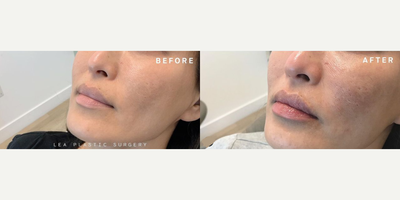 Woman treated with Restylane Refyne - Woman treated with Lip Fillers using Restylane Refyne.