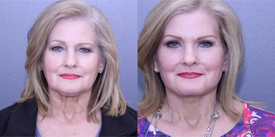 55-64 year old woman treated with Lifestyle Lift - Patient had Lifestyle Lift, Upper and Lower Bleph, FF Laser, and Brow Lift