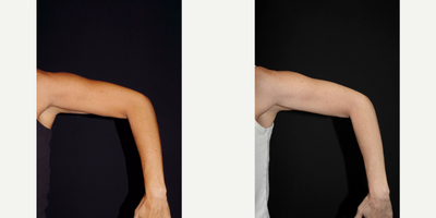 45-54 year old woman treated with Venus Legacy (and CoolSculpting) - 48 year old female received CoolSculpting and Venus Legacy to the arms; photos depict the patient's results 6 months post-CoolSculpting and 3 months post-Venus Legacy.