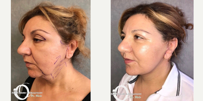 45-54 year old woman treated with Neck Lift - Upper eyelid surgery, face and neck lift