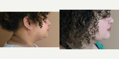35-44 year old woman treated with Liposuction - Submental/Neck Liposuction with Renuvion J plasma skin tightening.