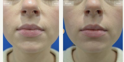 Woman treated with HydraFacial - HydraFacial/ Lip Perk