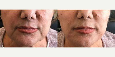 Radiesse - Almost everyone develops loss of volume in their face as they age. Problem areas are usually the loss of elasticity in the cheeks. Here, Dr. Marciano used 3 syringes of Radiesse to help support the cheeks and jowl lines