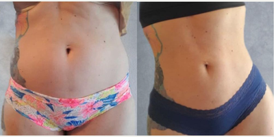 Woman treated with Brazilian Butt Lift - Woman treated with Brazilian Butt Lift