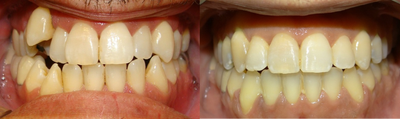 17 or under year old man treated with Clear Braces - Dental Problems: Class III malocclusion. Space deficiency on the upper and lower arches. Constricted maxilla. Posterior cross bite. Partial Anterior Cross Bite.

Doctors Notes: Comprehensive orthodontic treatment with fixed appliances. Non Extraction approach to give the patient a nicer and fuller smile. RME Hyrax Expander. Class III therapy. Non Surgical Conservative Approach to Tx.
Vertical therapy. Posterior cross bite corrected. Upper and lower arches were ideally aligned. Ideal Overbite was established. Occlusion is still slightly Class III due to growth. Patient was placed on lower fixed upper removable retainers.&nbsp;