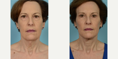Woman treated with Lower Facelift - Woman treated with Lower Facelift