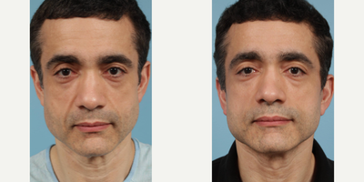 Man treated with Lower Facelift - Man treated with Lower Facelift