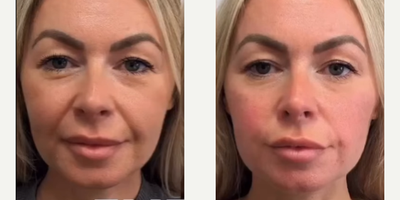 Woman treated with Emface - The revolutionary EMFACE treatment is now available in Pasadena. More lift, more volume, less wrinkles, no needles, no pain, no downtime