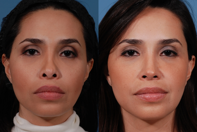 Revision Rhinoplasty - 	This patient underwent open secondary (revision) rhinoplasty with rib cartilage grafts to correct problems that arose from a prior surgery with another physician.