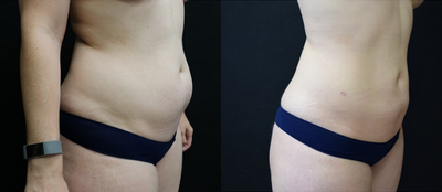 Liposuction - Liposuction of abdomen and flanks