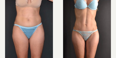 Woman treated with Power-Assisted Liposuction (PAL) - Mini Abdominoplasty + PAL HD Liposculpture + Renuvion the abdomen, flanks and inner thighs. Picture taken 2 months post op.