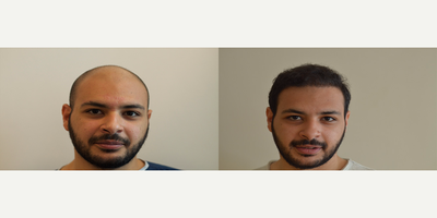 25-34 year old man treated with Hair Transplant - 4200 Grafts
FUE methods front, middle and back areas Lateral slit incision technique.