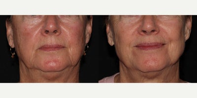 45-54 year old woman treated with Laser Genesis, Laser Resurfacing, Excel V - Patient was treated with laser treatments to clear up skin and treat rosacea / redness.