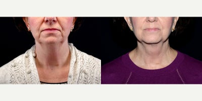 60 year old woman treated with PrecisionTx - 60 year old woman treated with PrecisionTx. Photos depict before and 6 months after surgery.