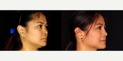 38 year old woman treated with Asian Rhinoplasty. - 38 year old woman treated with Asian Rhinoplasty. Photos depict before and 10 months after surgery.