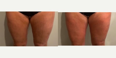 25-34 year old woman treated with Body Wrap - Before and immediately after one Bioslimming Body Wrap at Wise Med Spa