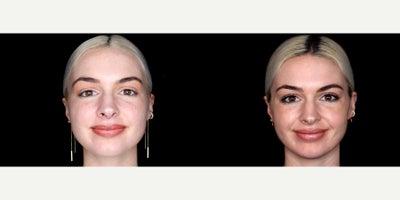 27 year old woman treated with Thread Lift - 27 year old woman treated with Thread Lift. Photos depict before and 1 month after 10 novathreads.