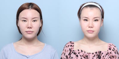 25-34 year old woman treated with Cheekbone Reduction - Zygomatic Bone Surgery (Cheekbone Reduction)Square Jaw Reduction Surgery