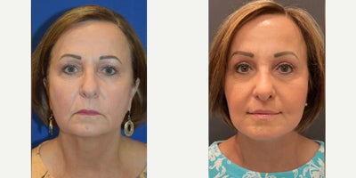 55-64 year old woman treated with Brow Lift - Before and After: A-Lift + Lateral Brow Lift + Lip Lift + Upper Blepharoplasty