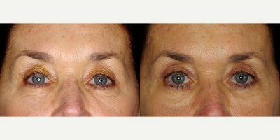 66 year old woman treated with Restylane Refyne - 66 year old woman treated with Restylane Refyne to under eyes. Photos depict before and 2 months after 1 syringe.
