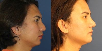 25-34 year old transgender woman treated with Buccal Fat Removal - Facial Gender Affirmation Surgery