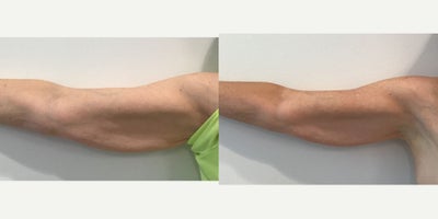 55-64 year old woman treated with truSculpt iD to her upper arms - This 64 year old female came in to discuss non-invasive options for her upper arms. She wanted to have truSculpt iD to her arms and she was treated in that area with 1 panel on each arm. The photos shown are 4 months after one treatment.
