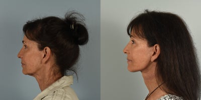 65-74 year old woman treated with Facelift - 68 year old female who underwent Facelift, Neck Lift, CO2 laser resurfacing and fat grafting 3 months ago.